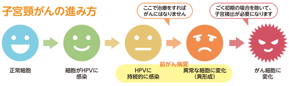 子宮頸がんの進み方 正常な細胞がHPVに持続的に感染し、異常な細胞に変化(異形成)していくと前がん病変という状態になります。ここで治療をすればがんにはなりません。これが進行し癌細胞に変化してしまうと、ごく初期の場合を除いて子宮摘出が必要になります