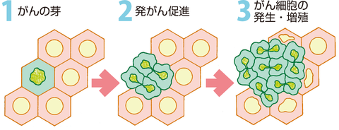 がん細胞の発生。１、がんの芽。２、発がん促進。３、がん細胞の発生、増殖