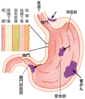 胃がん 胃がん