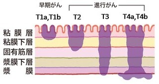 胃壁の浸潤度 胃壁の浸潤度