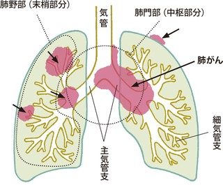 肺がん全体像