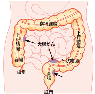 大腸がん