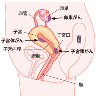 子宮がん 子宮がん