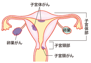 子宮頸がんと子宮体がん 子宮頸がんと子宮体がん
